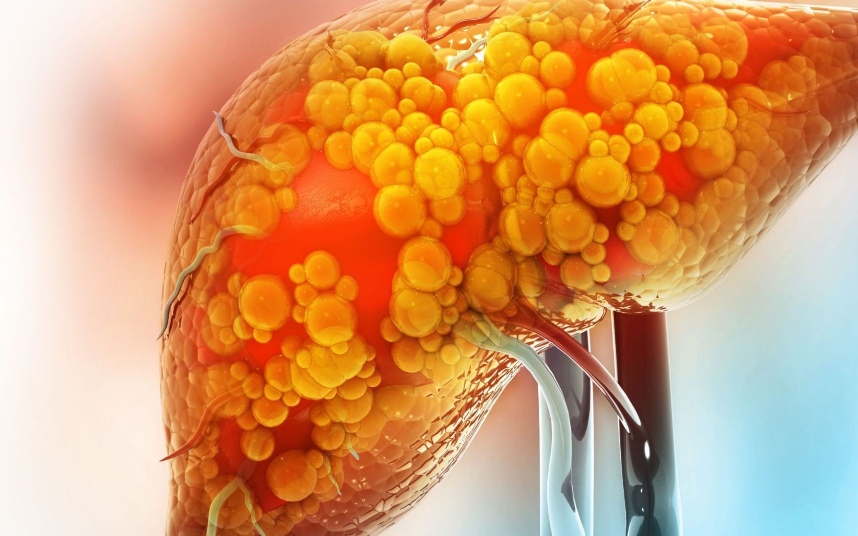 Một loại đồ uống quen thuộc hỗ trợ cải thiện gan nhiễm mỡ- Ảnh 2. 5 bước quan trọng phòng ngừa biến chứng gan nhiễm mỡ không do rượu