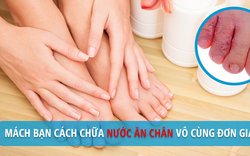 cach chua nuoc an chan 17572329944631867874226 0 74 628 1079 crop 175723300563821646835