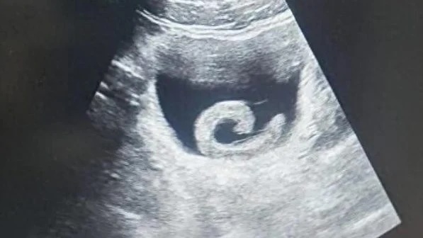 Người đàn ông phải nhập viện cấp cứu vì… đỉa sống trong bàng quang