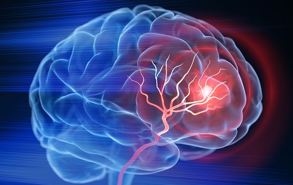 TIA (cơn thiếu máu não thoáng qua) được xem là dấu hiệu cảnh báo sớm của đột quỵ não