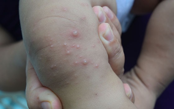 Cứu sống ngoạn mục cháu bé mắc tay chân miệng nguy kịch trong những ngày Tết- Ảnh 2. 7 cách phòng bệnh tay chân miệng ở trẻ em