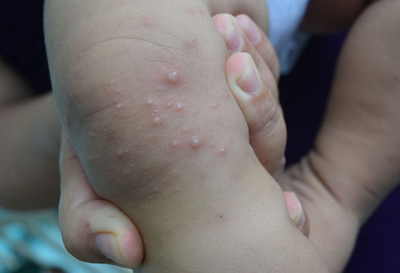 7 cách phòng bệnh tay chân miệng ở trẻ em- Ảnh 1.