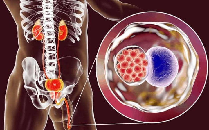 Khi nào nên làm xét nghiệm Pap để sàng lọc ung thư cổ tử cung?- Ảnh 4. 3 bệnh lây truyền qua đường tình dục làm tăng nguy cơ ung thư cổ tử cung