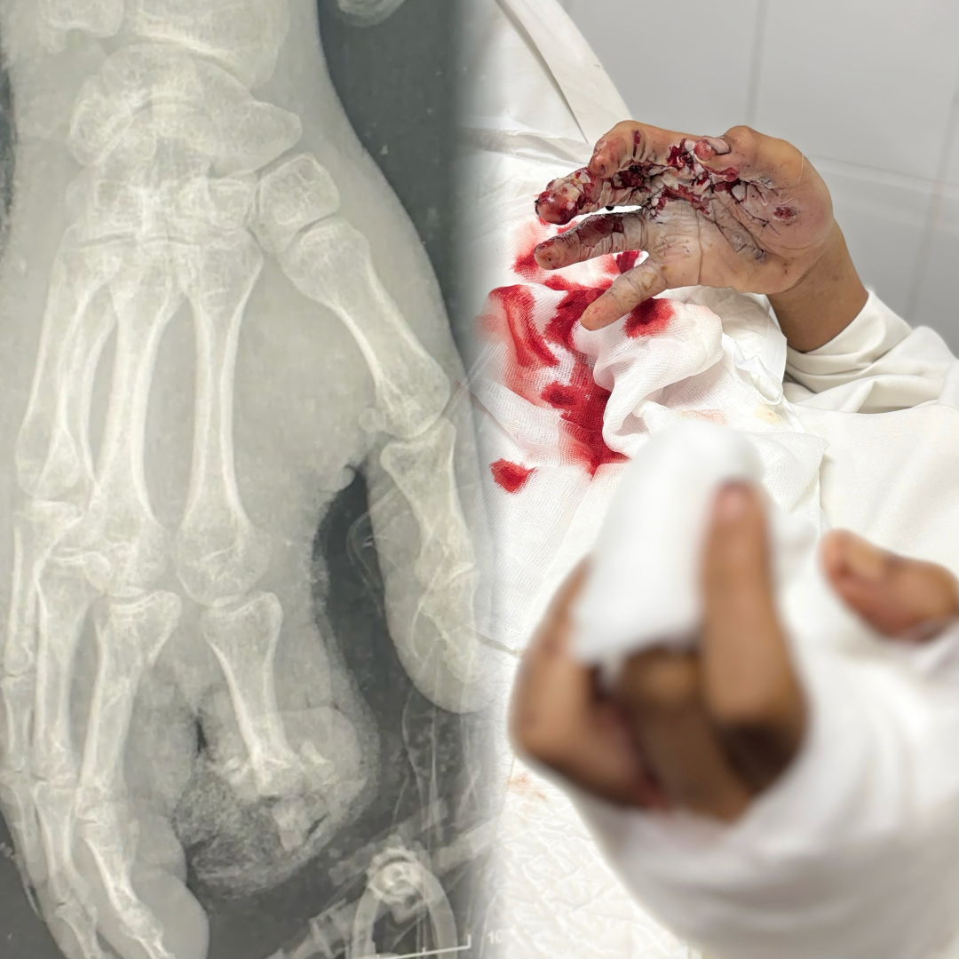 Trẻ 15 tuổi bị biến dạng khuôn mặt, tổn thương nghiêm trọng do tai nạn pháo nổ- Ảnh 1.