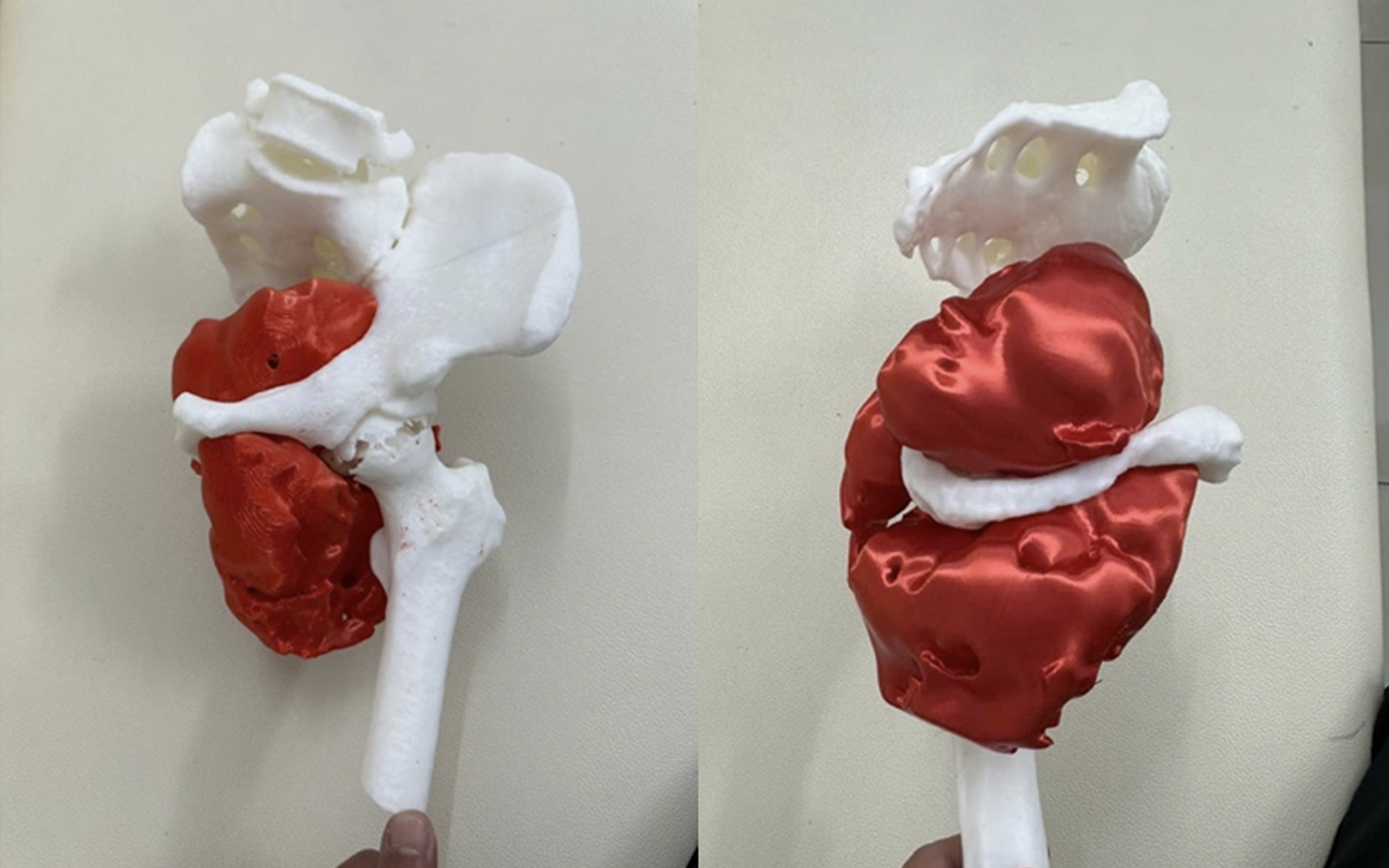 Cứu sống bệnh nhân ung thư hiếm gặp bằng phẫu thuật tháo nửa khung chậu