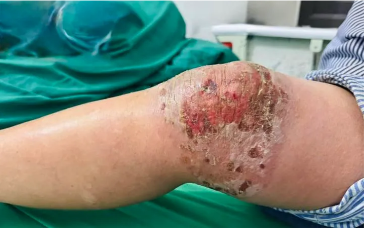 Viêm da, nhiễm trùng nặng do tự đắp thuốc nam, thuốc lá để điều trị đau khớp