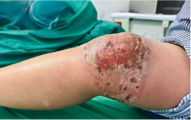 Viêm da, nhiễm trùng nặng do tự đắp thuốc nam, thuốc lá để điều trị đau khớp- Ảnh 1.