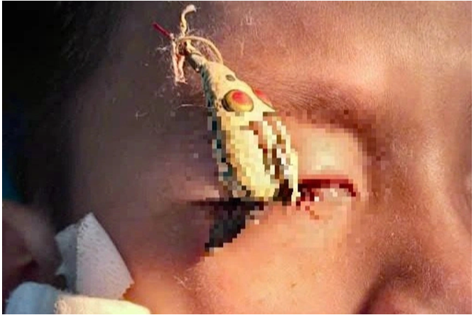 Suýt mù mắt khi đi câu cá, cảnh báo tai nạn nghiêm trọng- Ảnh 1.