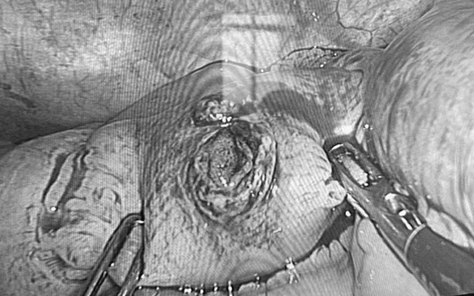 Phẫu thuật nội soi cấp cứu thành công cho nam thanh niên bị đinh xuyên thủng ruột non 