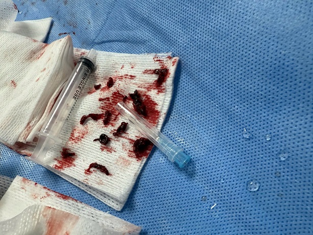 Hút nhiều cục máu đông cứu cụ ông 97 tuổi khỏi nguy cơ cắt cụt tay- Ảnh 3.