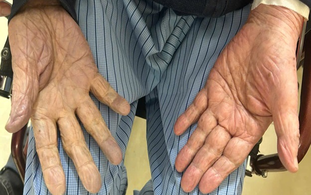 Ổ sán trong đường mật người đàn ông hay ăn đồ tái sống- Ảnh 3.