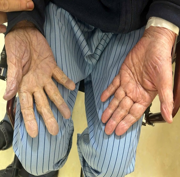 Hút nhiều cục máu đông cứu cụ ông 97 tuổi khỏi nguy cơ cắt cụt tay- Ảnh 2.