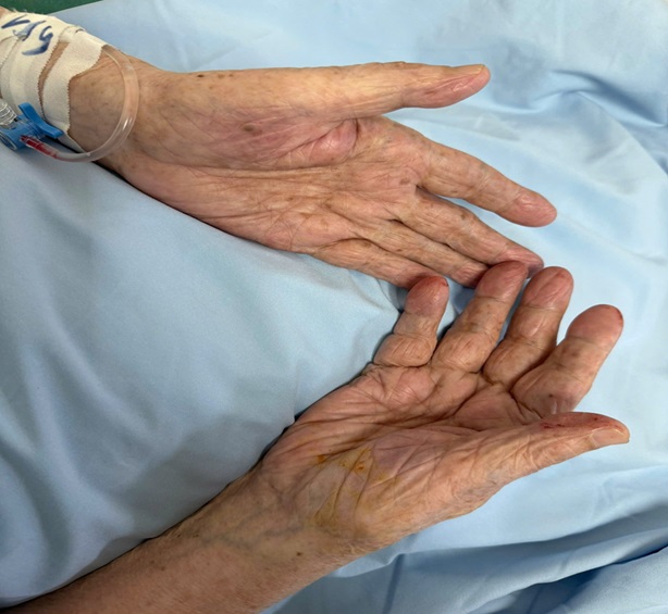 Hút nhiều cục máu đông cứu cụ ông 97 tuổi khỏi nguy cơ cắt cụt tay- Ảnh 4.