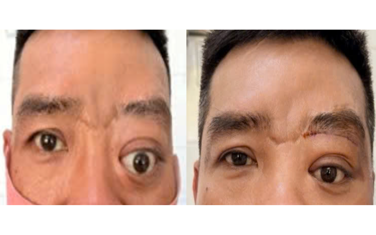 Bệnh hiếm gây lồi mắt, 20 năm Bệnh viện Tai Mũi Họng TPHCM chỉ gặp 2 ca