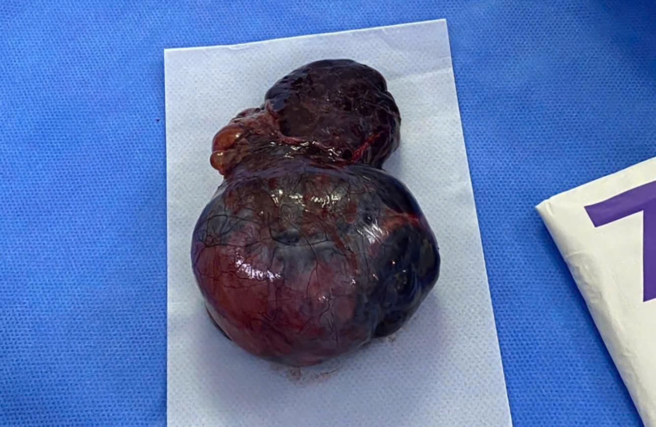 Thai phụ 34 tuần nguy kịch vì u buồng trứng xoắn hoại tử- Ảnh 3.