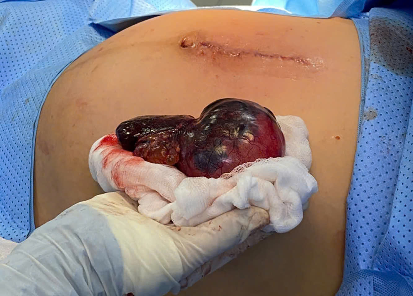 Thai phụ 34 tuần nguy kịch vì u buồng trứng xoắn hoại tử- Ảnh 2.