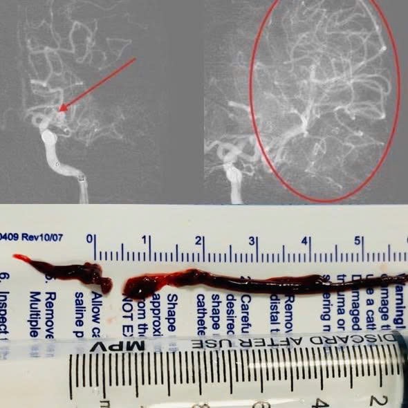 Đột quỵ trẻ hoá, lời cảnh báo của bác sĩ về căn bệnh này- Ảnh 2.