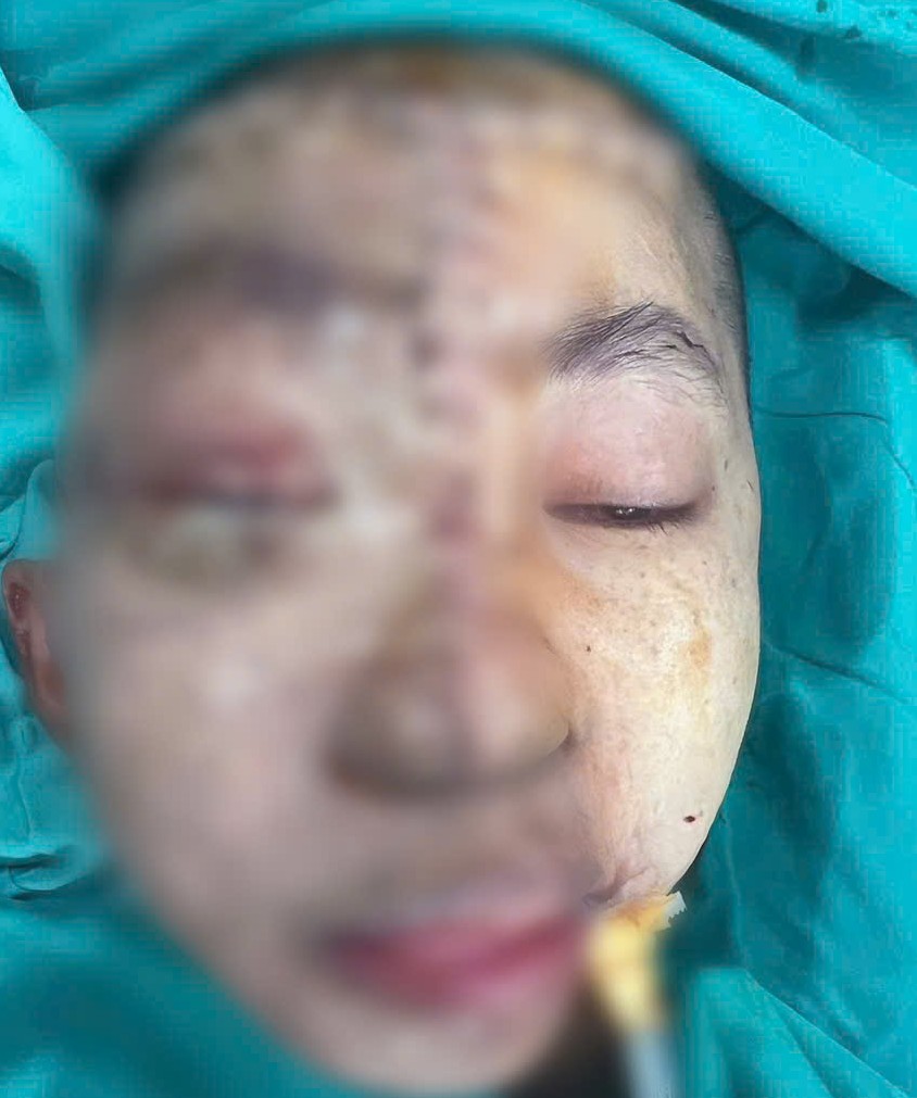 The 19-year-old underwent surgery after living with a huge tumor on her face for 17 years - Photo 2. 19-year-old girl had surgery after 17 years of having a giant facial tumor - Photo 2.