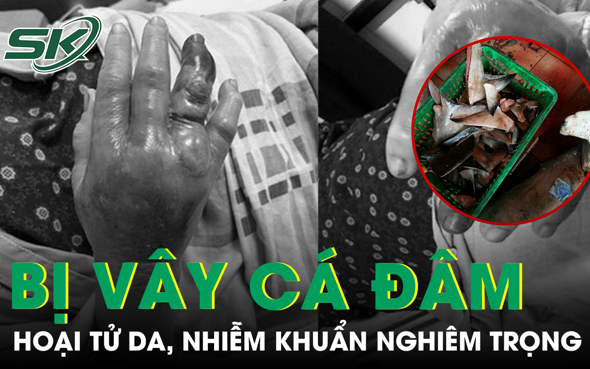 Người đàn ông hoại tử da chỉ vì một chiếc răng sâu- Ảnh 2.