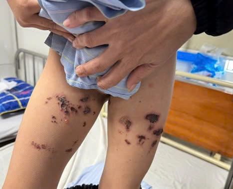 Bé trai bỏng nặng tầng sinh môn do nước tẩy bồn cầu bắn vào người- Ảnh 1. Bé trai bỏng nặng tầng sinh môn do nước tẩy bồn cầu bắn vào người- Ảnh 1.