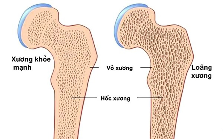 Cách phòng loãng xương sau mãn kinh- Ảnh 2.