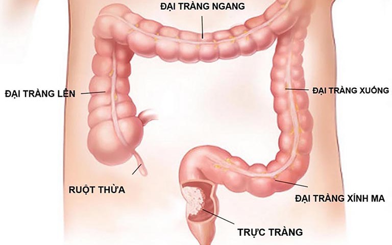 Những nguyên nhân có thể gây ra cơn nóng rát dạ dày- Ảnh 2. Những lưu ý quan trọng khi nội soi đại tràng, dạ dày bằng gây mê