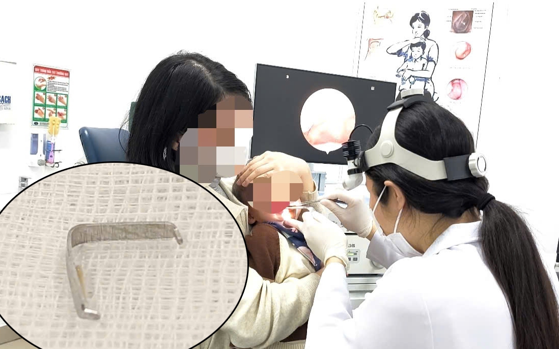 Thiếu niên 15 tuổi cấp cứu vì chiếc chày 18cm mắc kẹt hậu môn- Ảnh 5.