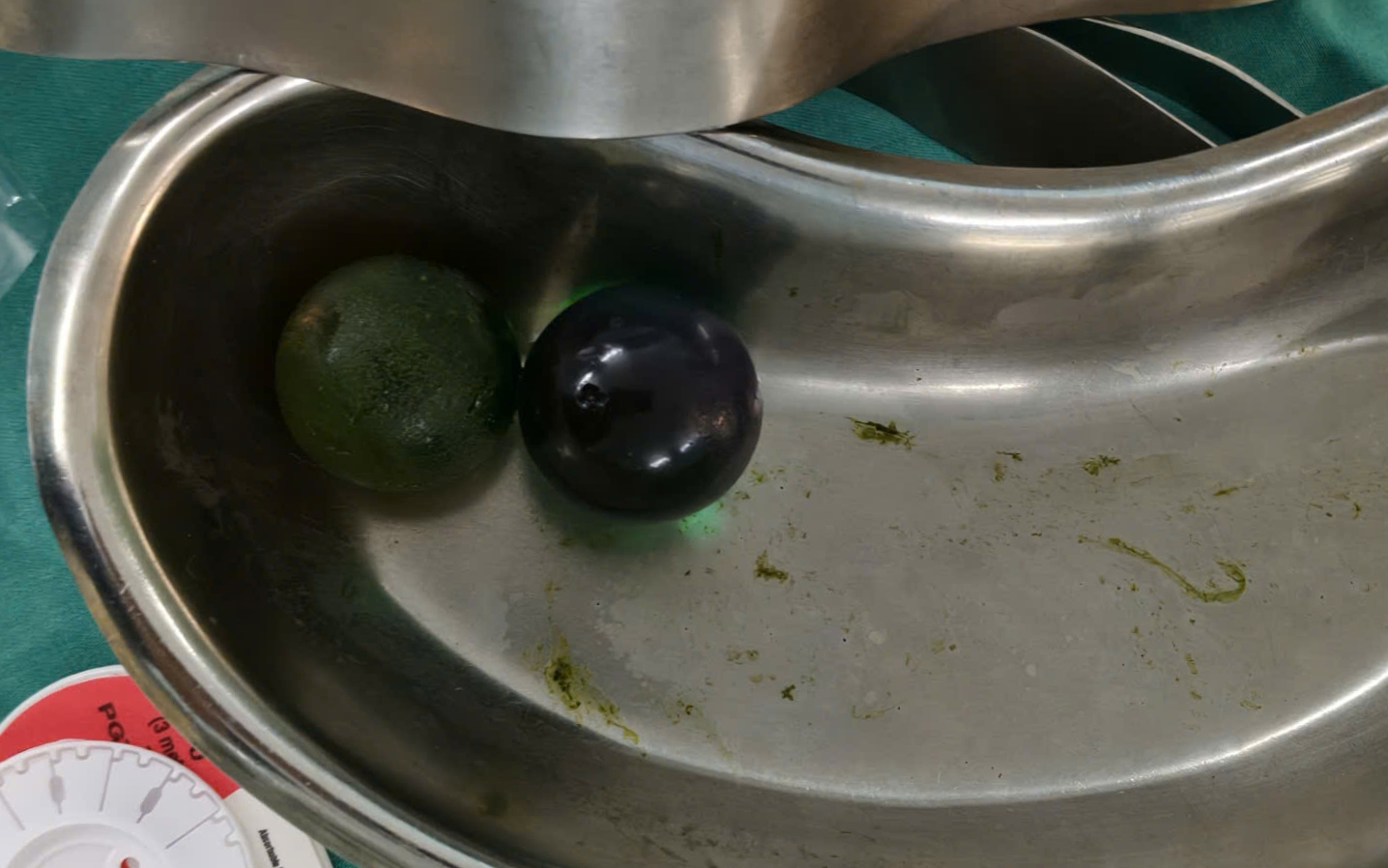 'Mở mắt là uống rượu', người đàn ông nôn ra cả lít máu- Ảnh 1.