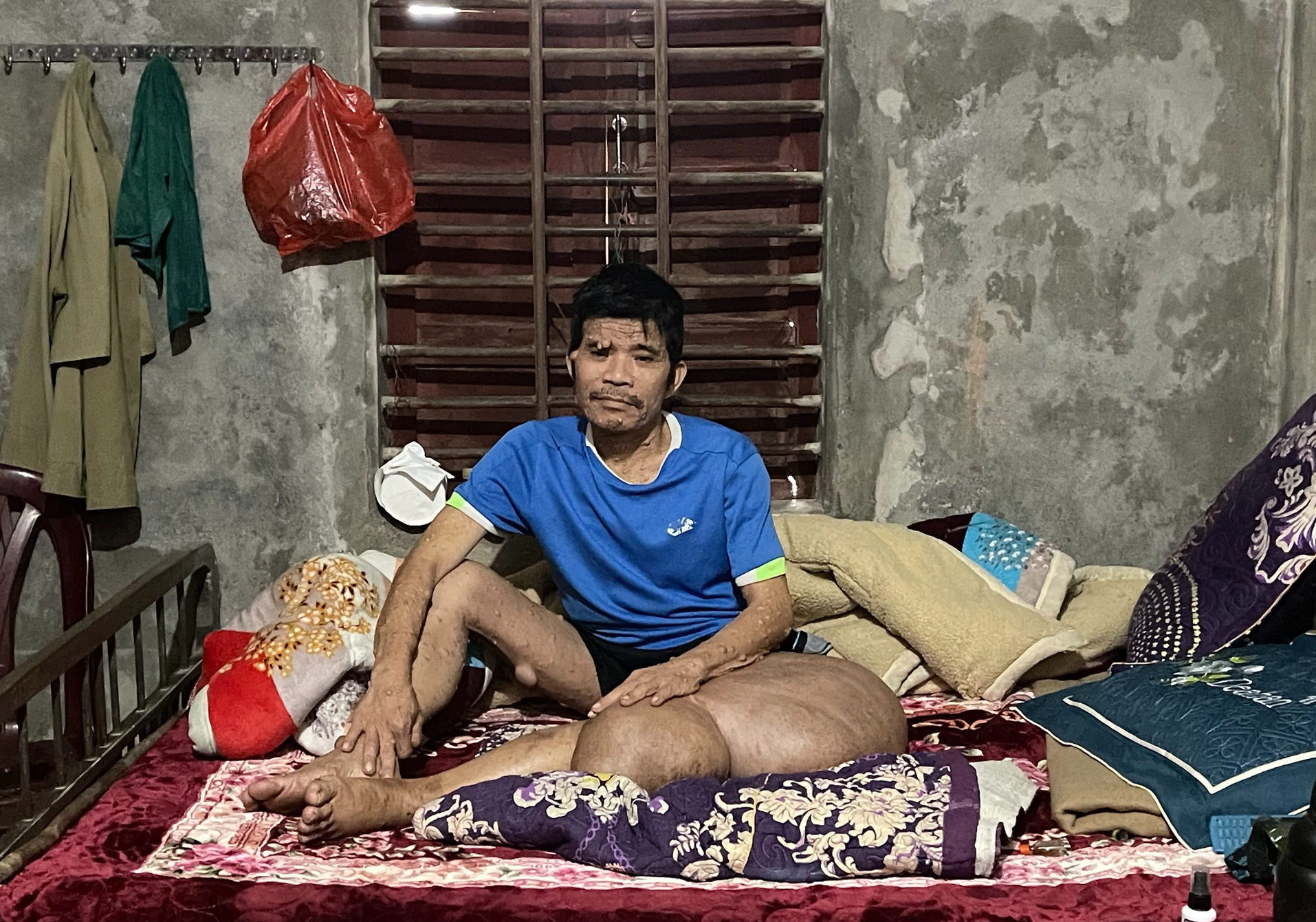 Người đàn ông có khối u khổng lồ đau xót nhìn vợ con lay lắt vì bệnh tật- Ảnh 1.