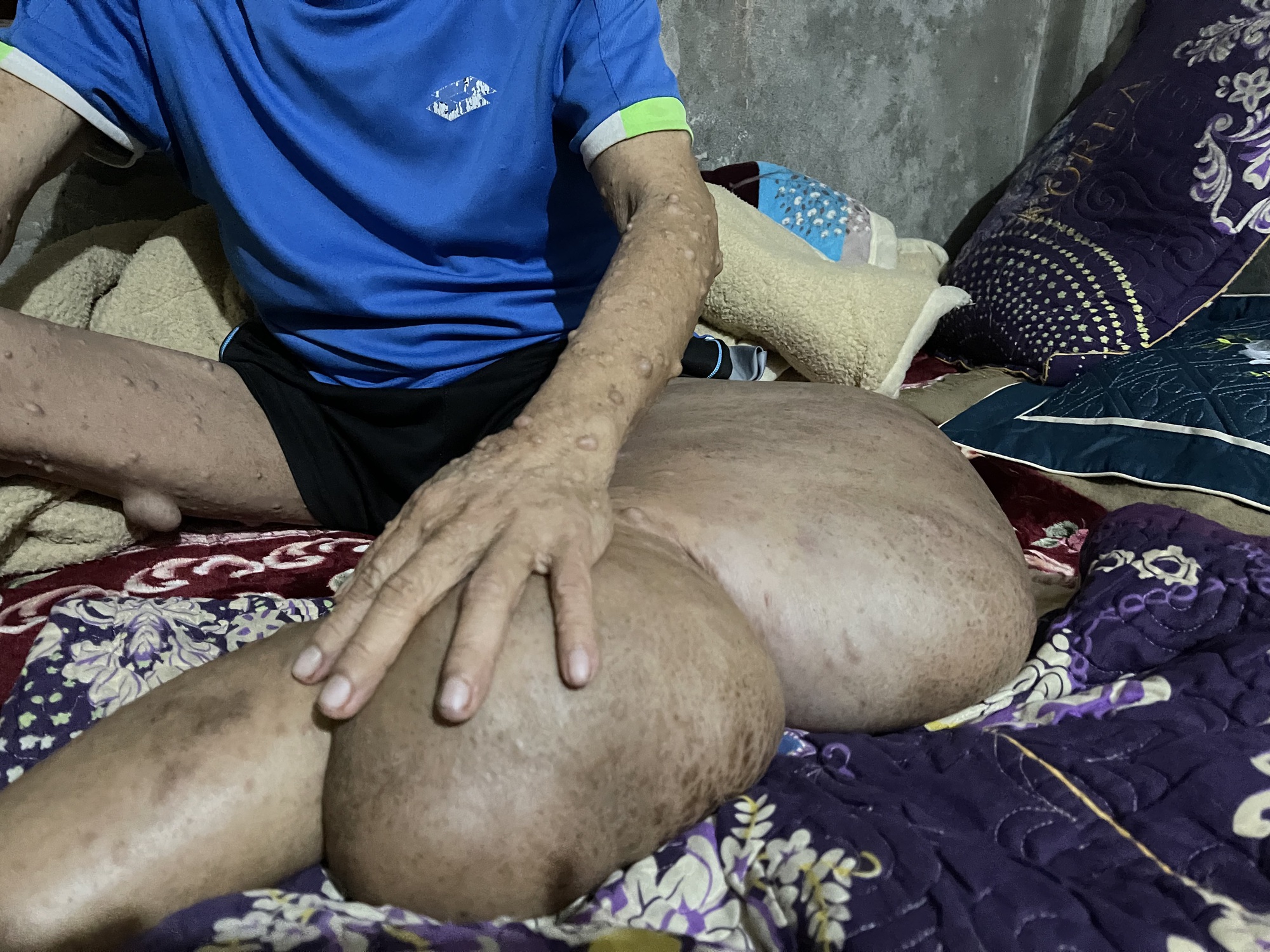 Người đàn ông có khối u khổng lồ đau xót nhìn vợ con lay lắt vì bệnh tật- Ảnh 4.