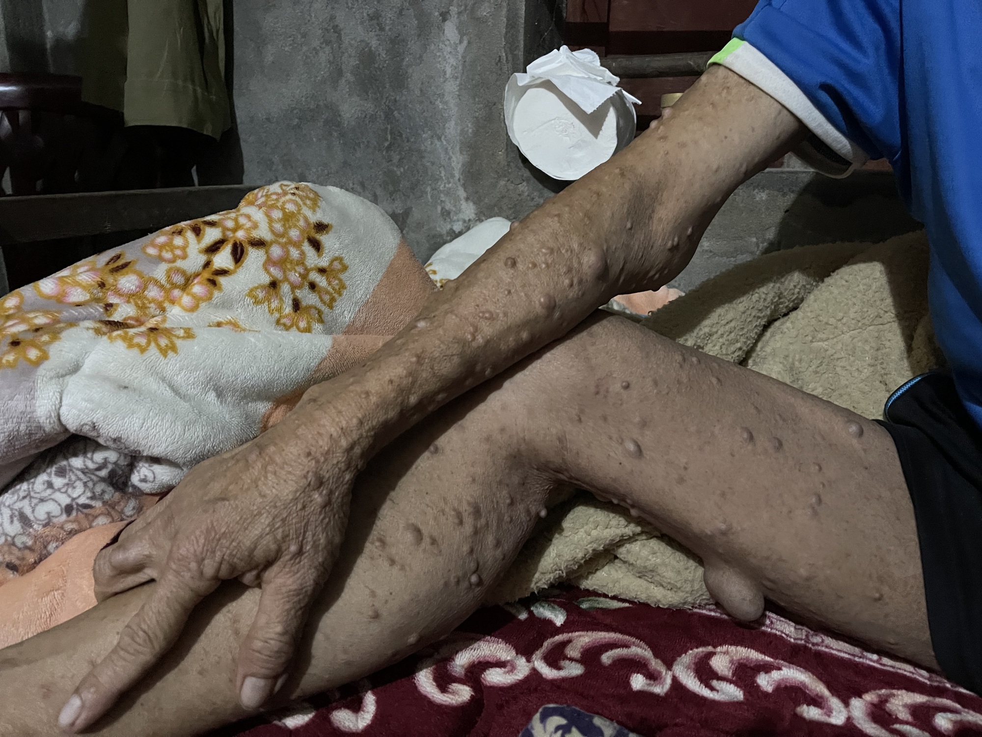 Người đàn ông có khối u khổng lồ đau xót nhìn vợ con lay lắt vì bệnh tật- Ảnh 3.