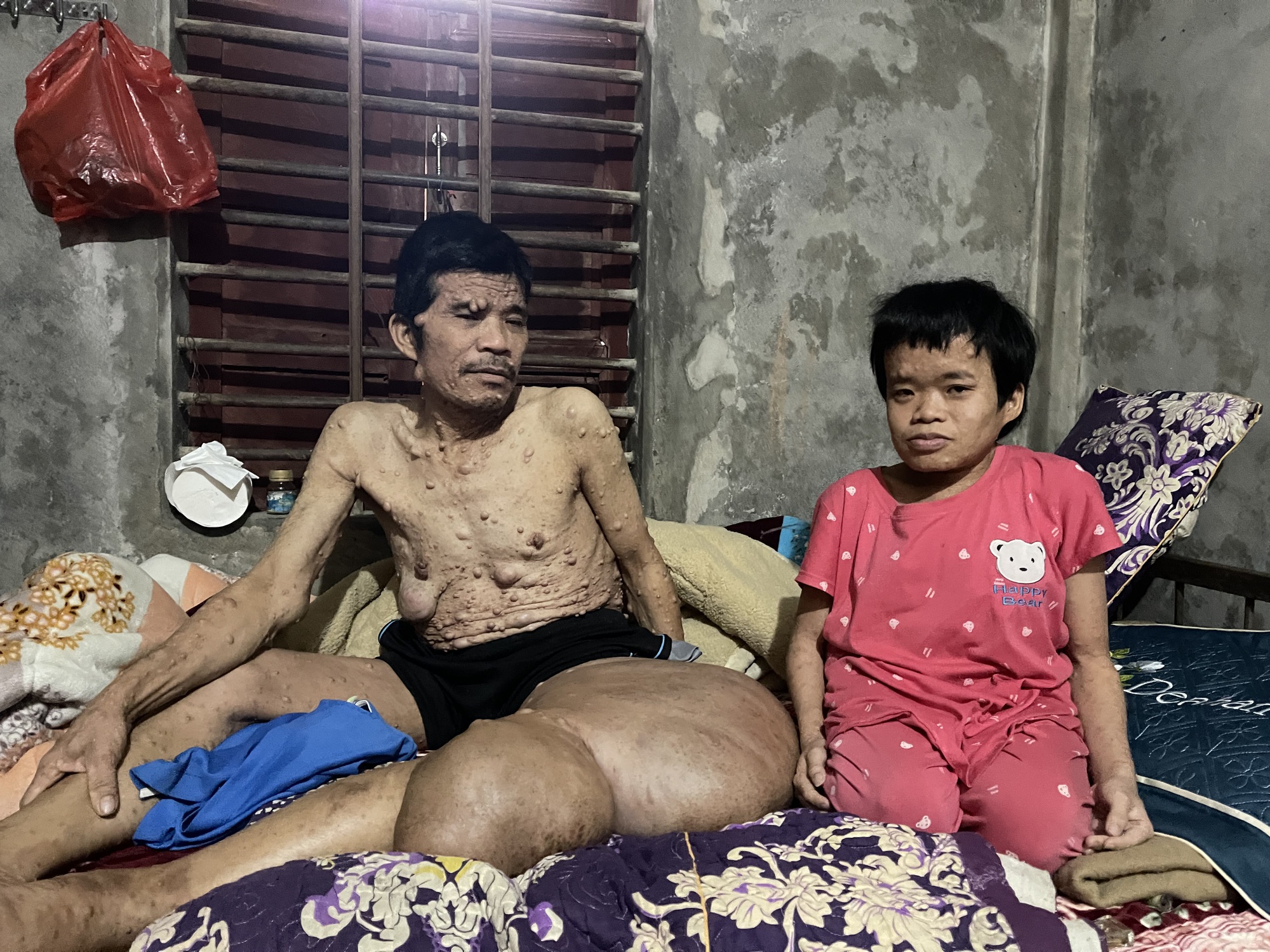 Người đàn ông có khối u khổng lồ đau xót nhìn vợ con lay lắt vì bệnh tật- Ảnh 2.