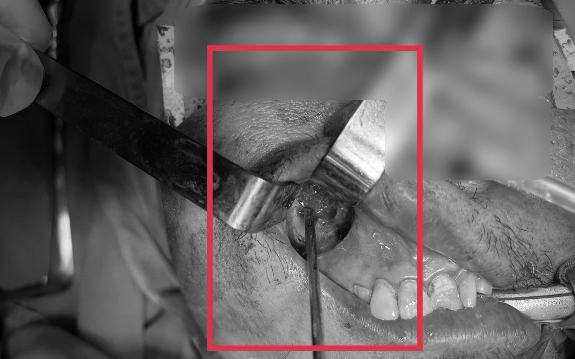 Người đàn ông hay ăn đồ sống và tiết canh, nhiễm sán dây gần 1m- Ảnh 3. Người đàn ông hay ăn đồ sống và tiết canh, nhiễm sán dây gần 1m- Ảnh 3.