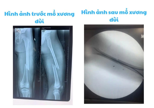 Bệnh viện Nhi Hải Phòng ứng dụng kỹ thuật C-arm trong phẫu thuật gãy xương trẻ em - Ảnh 2.