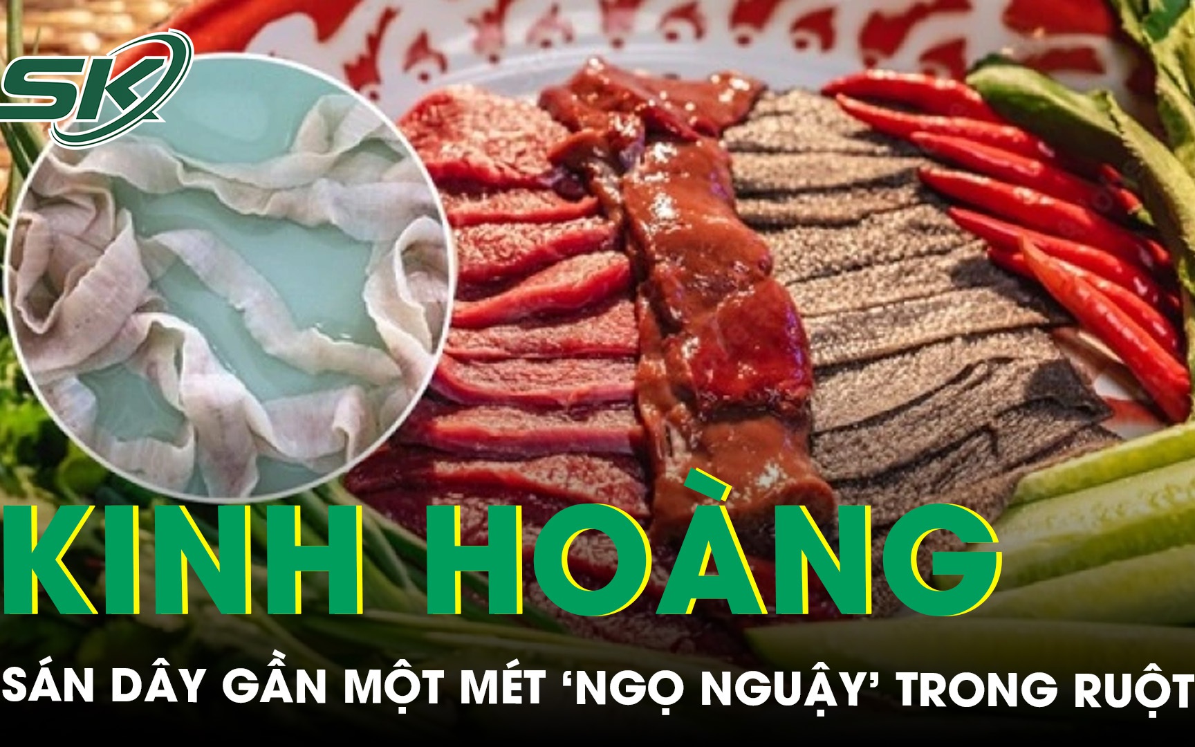 Kinh hoàng sán dây gần một mét ngọ nguậy trong ruột