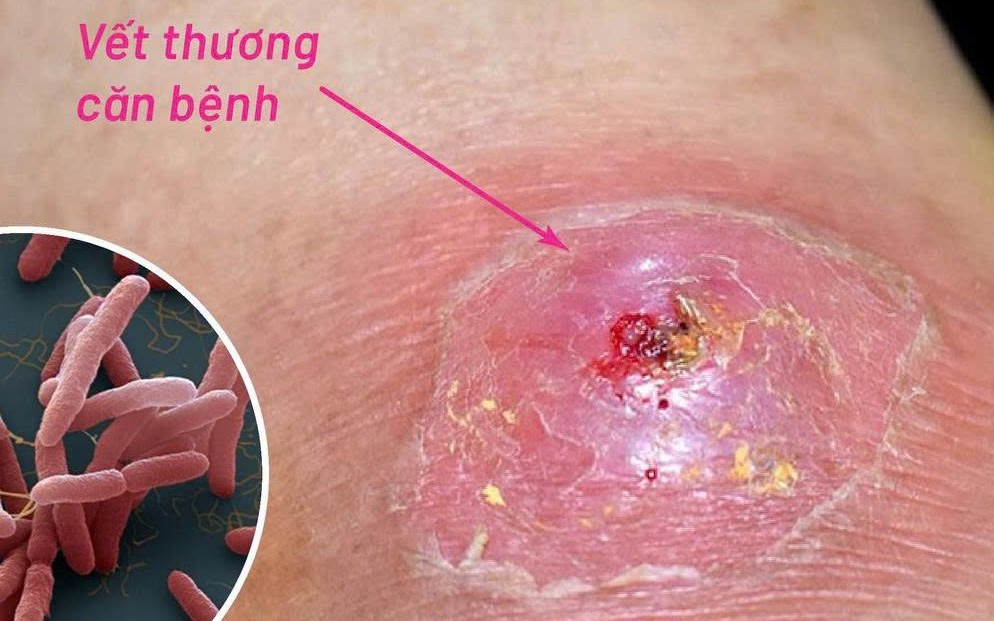 Bệnh Whitmore có thể gây tử vong: Phát hiện sớm bằng cách nào? - Ảnh 2.