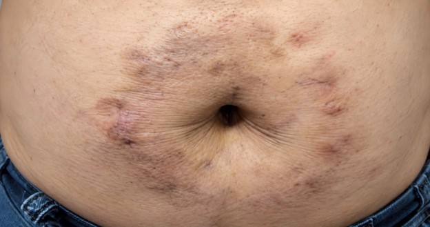 Tiêm insulin quanh rốn sai cách, đường huyết khó kiểm soát - Ảnh 1.