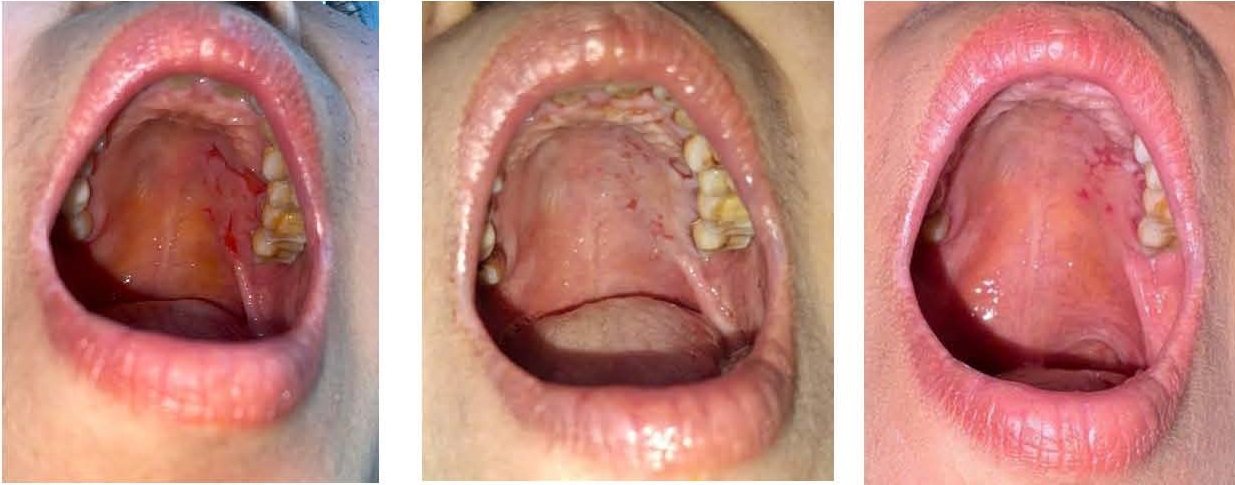 Lành vết trợt niêm mạc miệng, hết đau rát sau 7 năm vật lộn với bệnh Pemphigus - Ảnh 2.