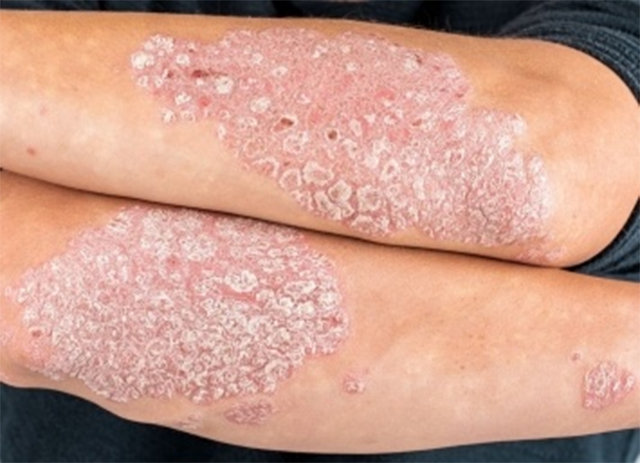 Tự tiêm corticoid chữa vảy nến, người đàn ông suy tuyến thượng thận- Ảnh 2.