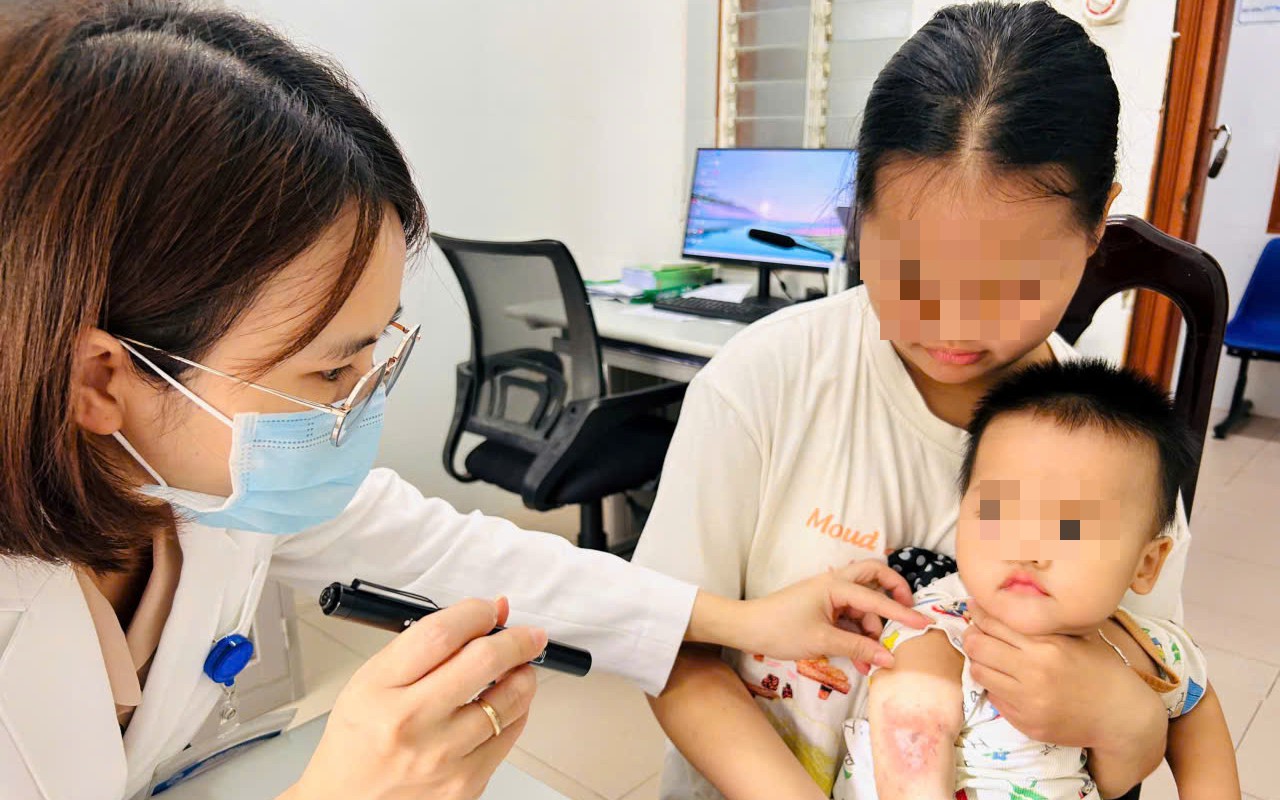 Viêm da tiếp xúc do kiến ba khoang, cách xử trí đúng tránh lan rộng- Ảnh 2.