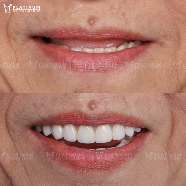 Không phải cứ mất răng là phải trồng răng Implant: Khi nào nên - khi nào không?- Ảnh 3.