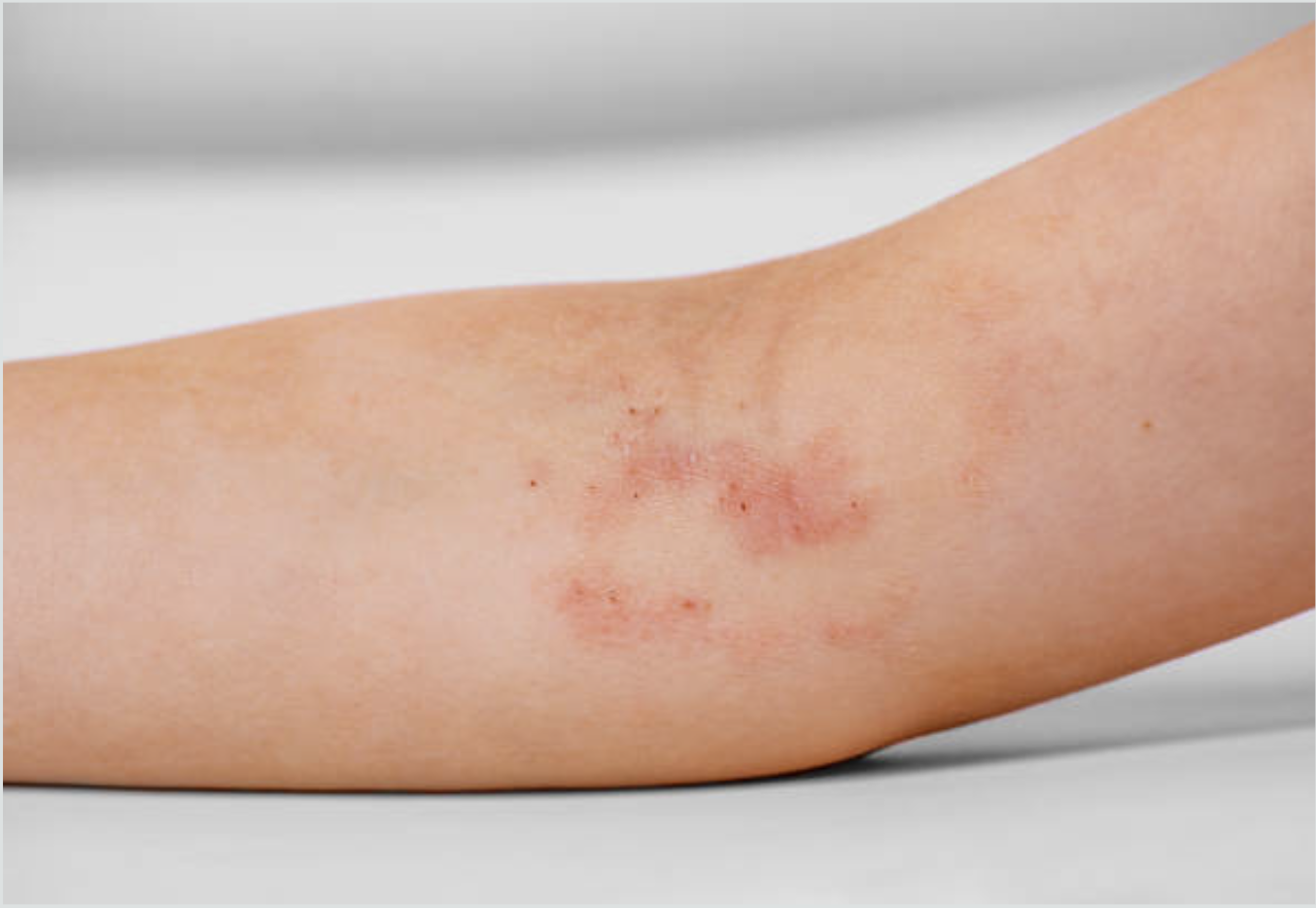 Xem nhẹ viêm da có thể bị tổn thương, nhiễm trùng nặng- Ảnh 1.