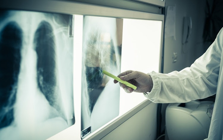 Gánh nặng bệnh lao cao nhất cả nước, TPHCM siết quản lý, tăng tốc kiểm soát lao- Ảnh 6.