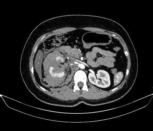 Bệnh viện 19-8 cấp cứu ca vỡ thận nguy kịch- Ảnh 1.