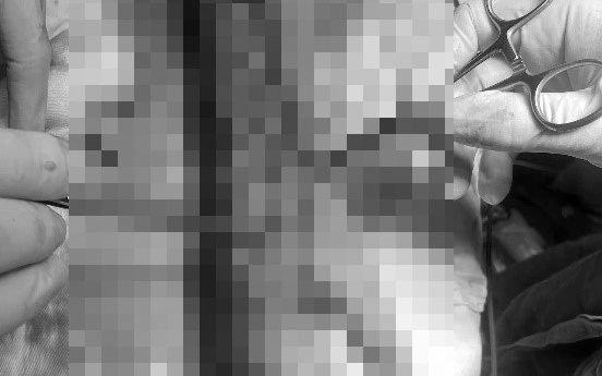 Dựng cây nêu vướng dây điện, người phụ nữ nguy cơ mất cẳng tay