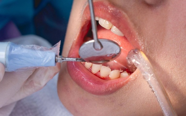 Những ai cần thận trọng khi lấy cao răng? 