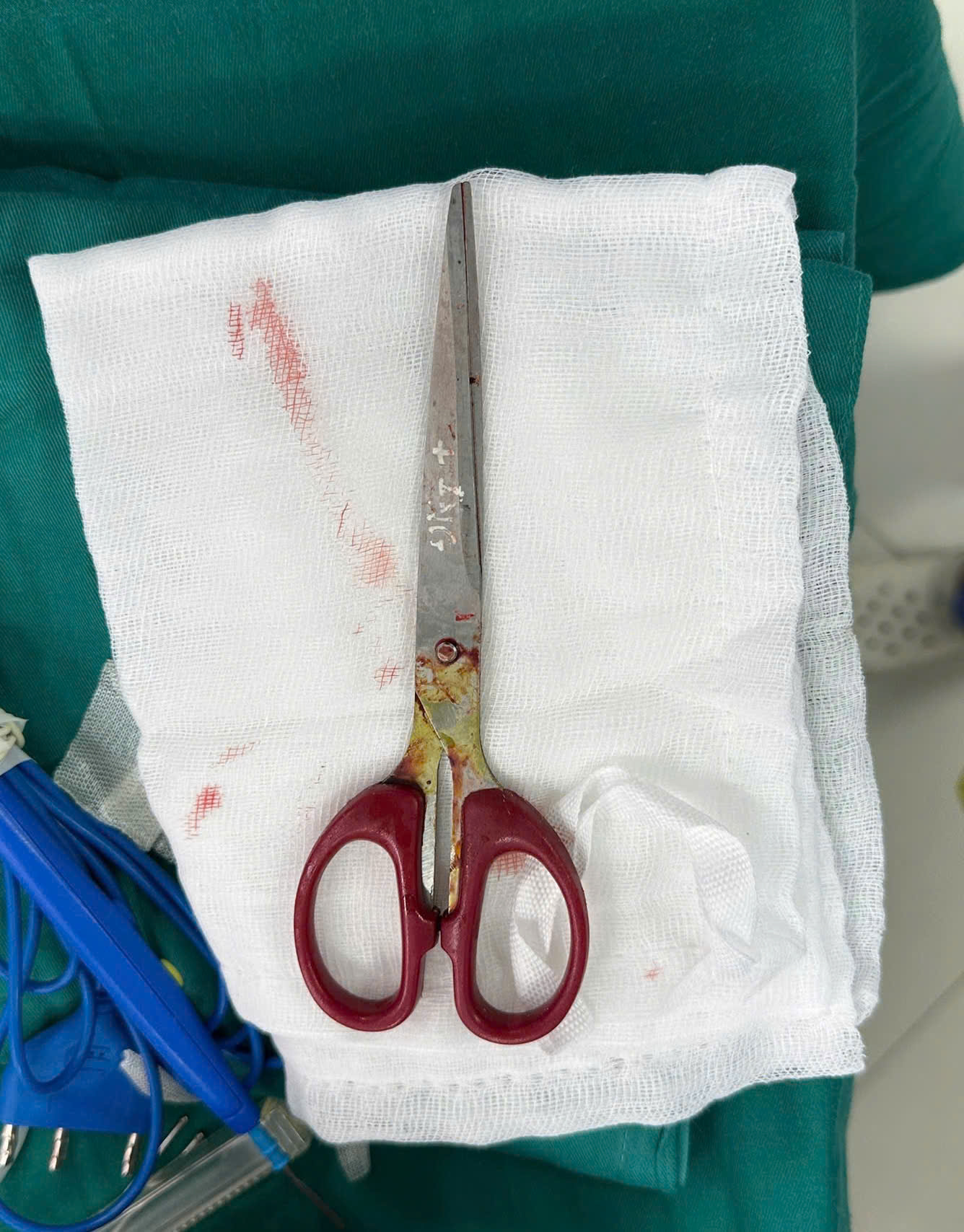 Hy hữu: Người bệnh nguy kịch do tự đâm kéo xuyên vùng đầu- Ảnh 3. Hy hữu: Người bệnh nguy kịch do tự đâm kéo xuyên vùng đầu- Ảnh 3.