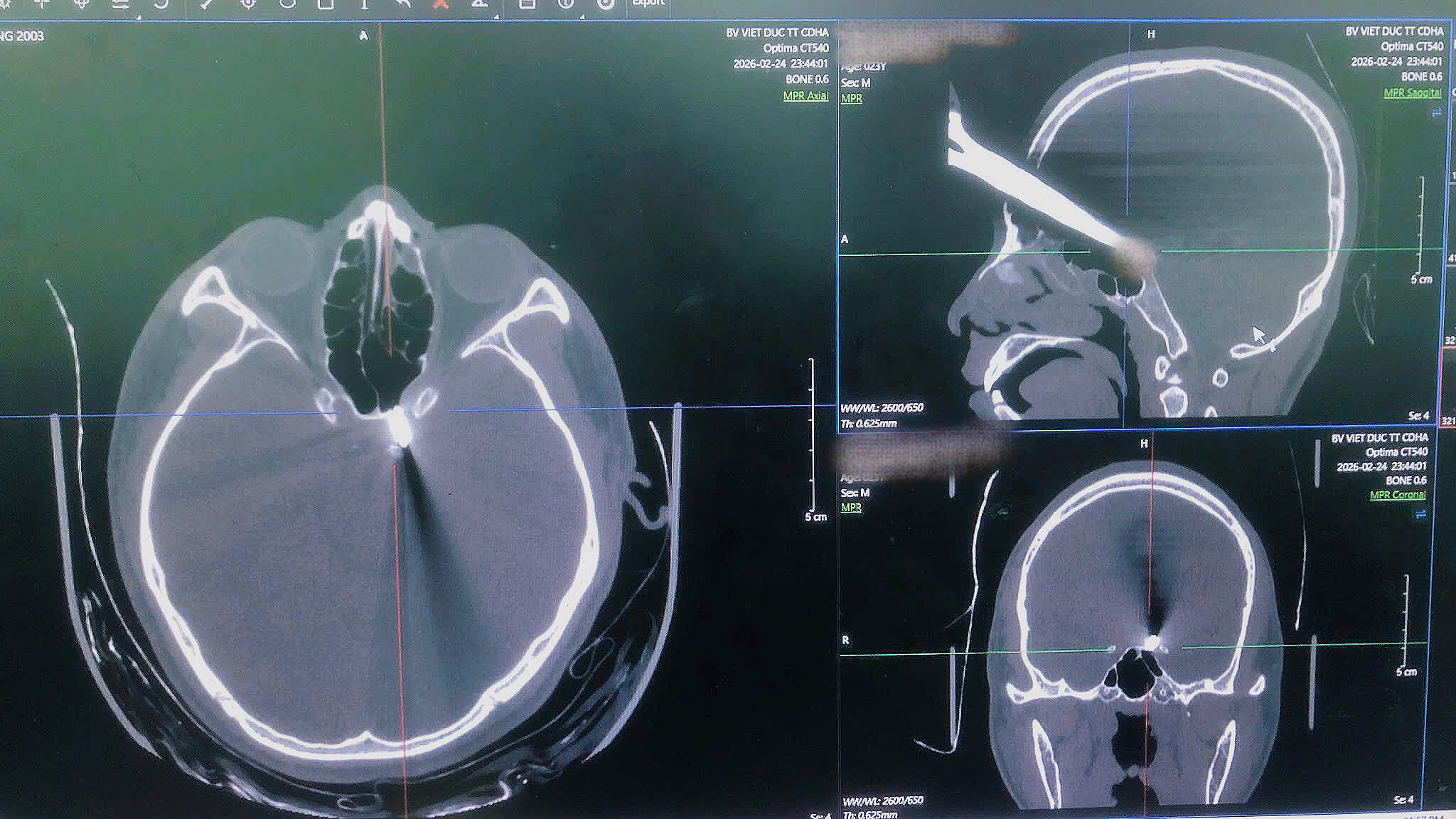 Hy hữu: Người bệnh nguy kịch do tự đâm kéo xuyên vùng đầu- Ảnh 1. Hy hữu: Người bệnh nguy kịch do tự đâm kéo xuyên vùng đầu- Ảnh 1.