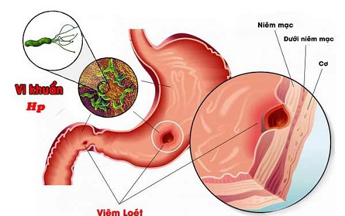 Tập luyện thể chất: Giải pháp không mất tiền phòng ngừa và hỗ trợ điều trị viêm loét dạ dày- tá tràng