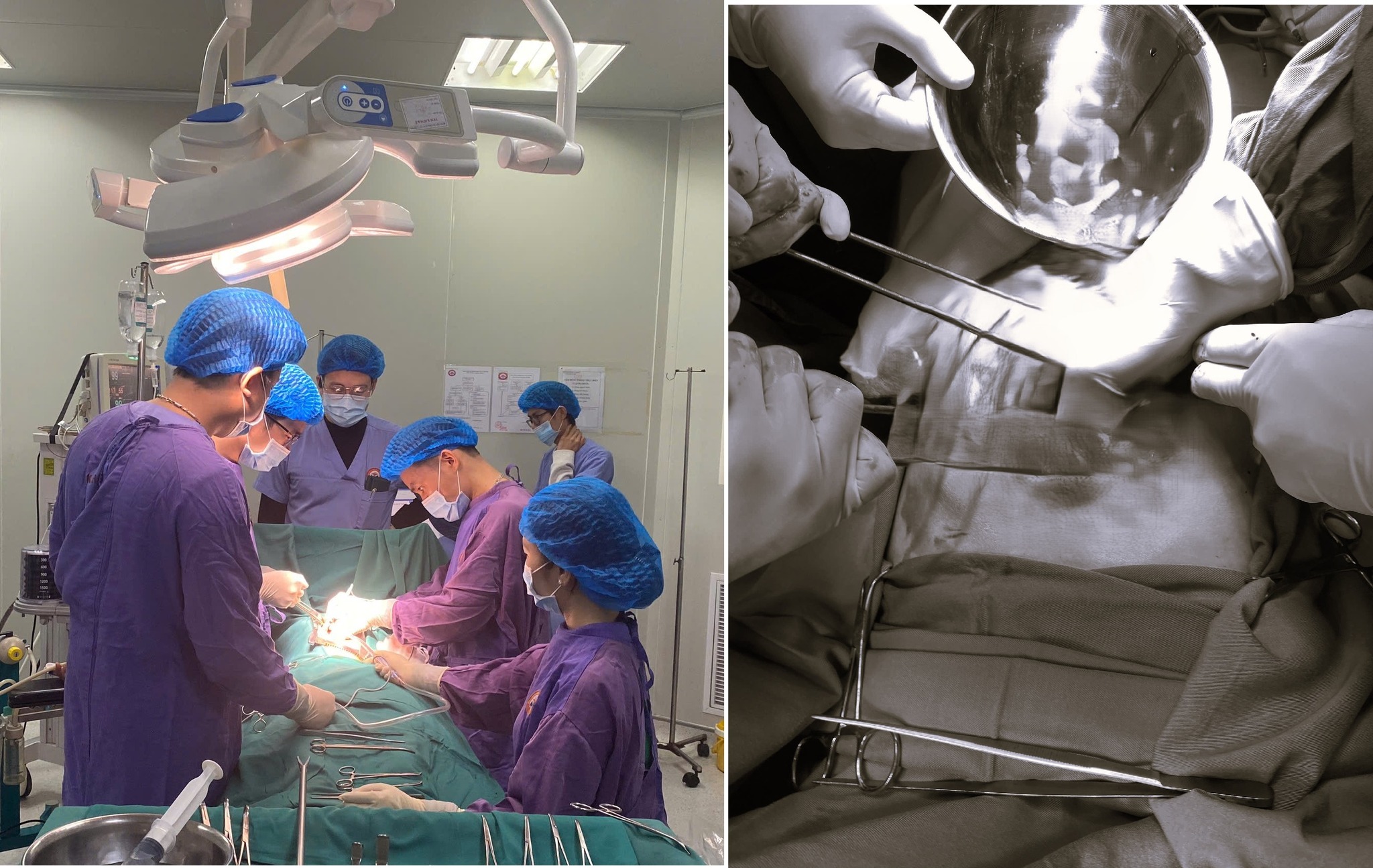 Dọn nhà đón Tết, bệnh nhân bị ngã từ độ cao 4 m, sốc đa chấn thương nguy kịch- Ảnh 1.